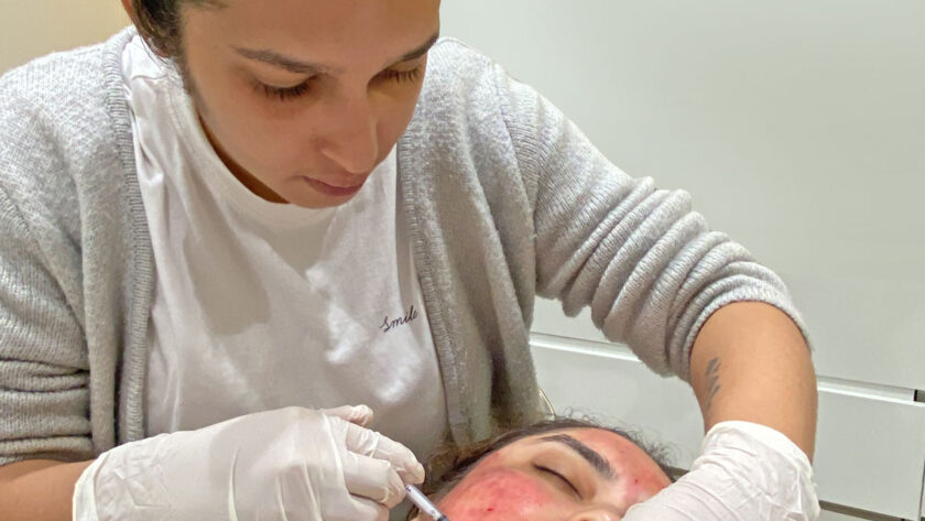 PRP facial treatment 