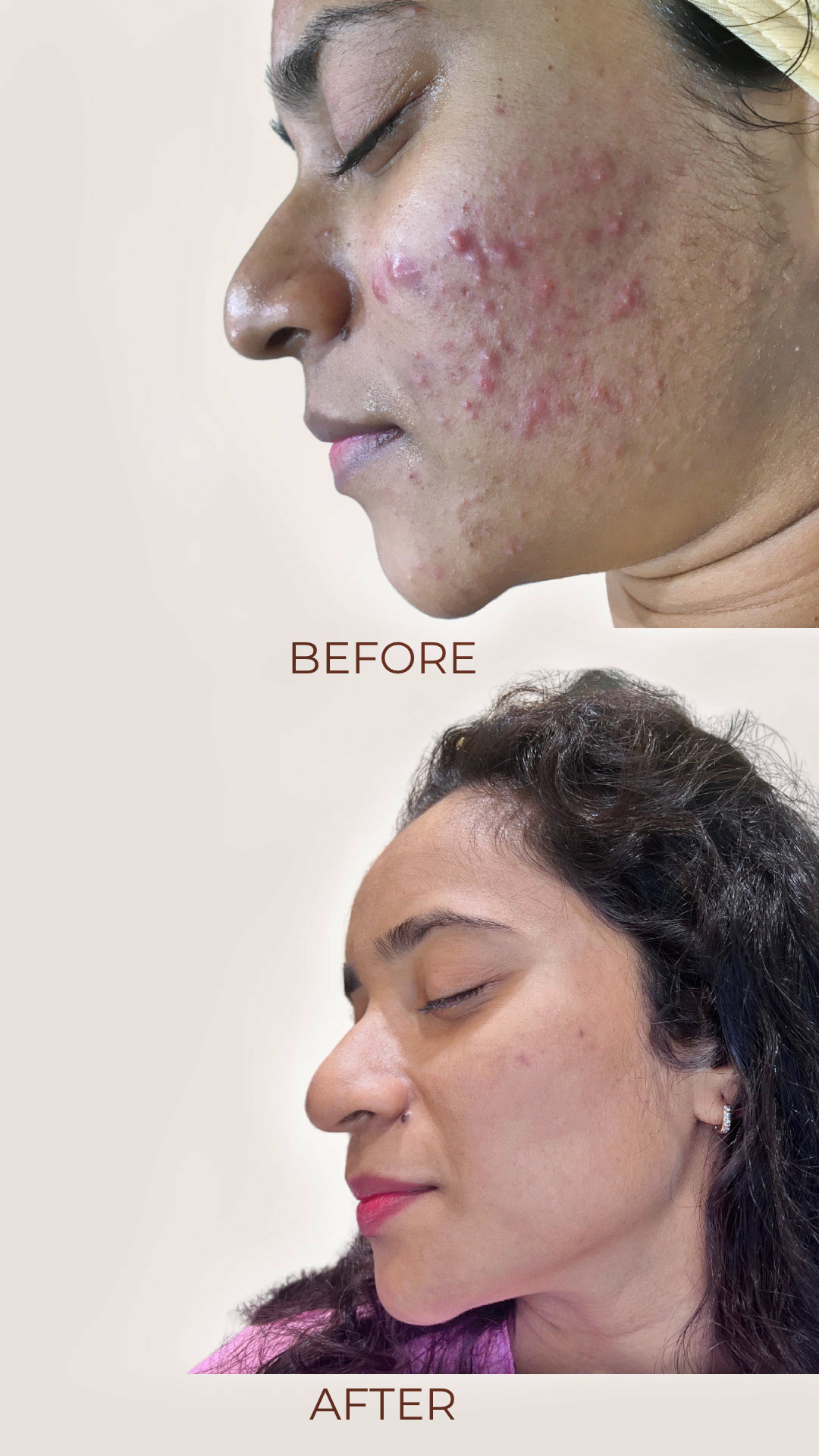 Before and after images showcasing the transformative results of The Skin Firm's Intense Acne Treatment at NIBM, revealing clear, healthy skin and reduced acne scars.