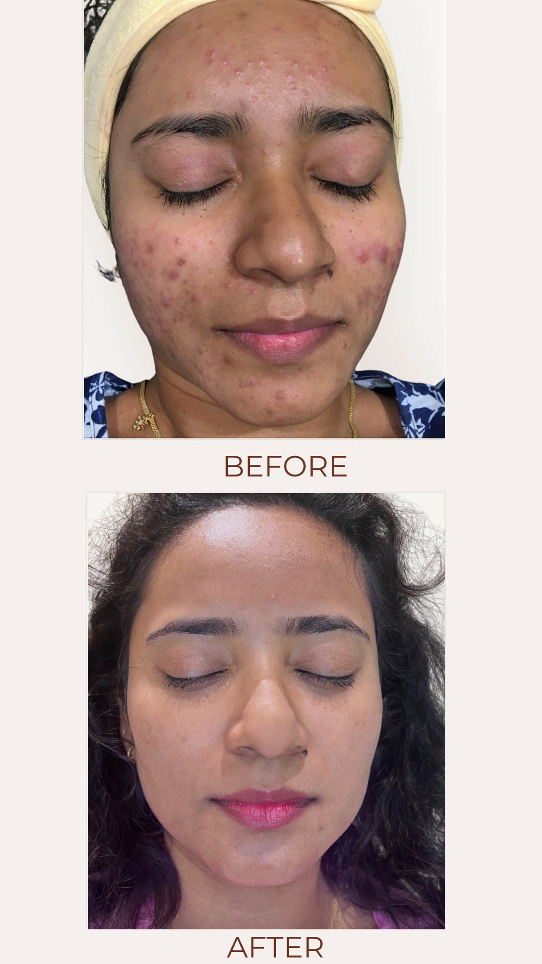 Before and after images showcasing the transformative results of The Skin Firm's Intense Acne Treatment at NIBM, revealing clear, healthy skin and reduced acne scars.
