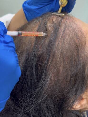 PRP hair treatment 