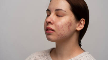 Acne Treatments in Pune 