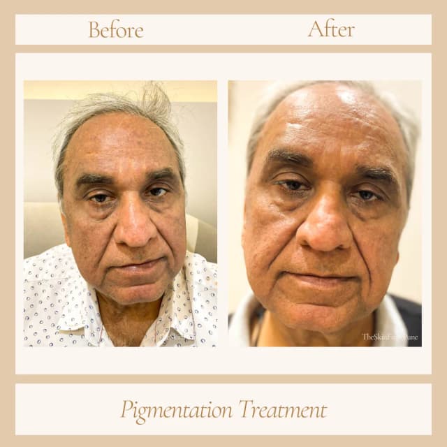 Pigmentation