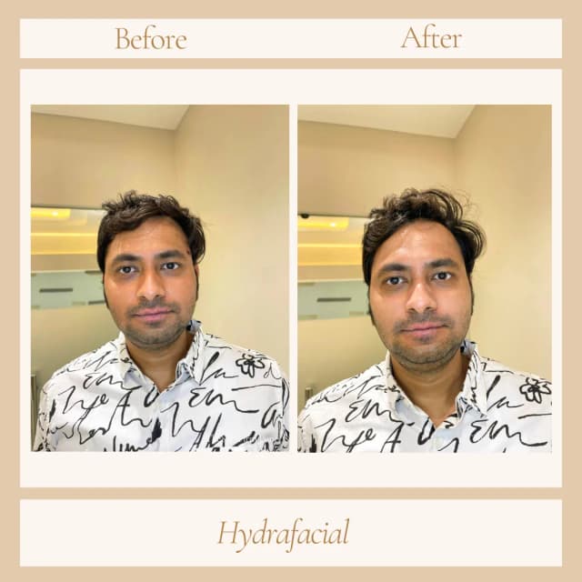 Facial
