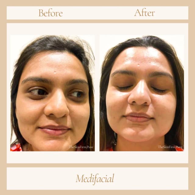 Facial