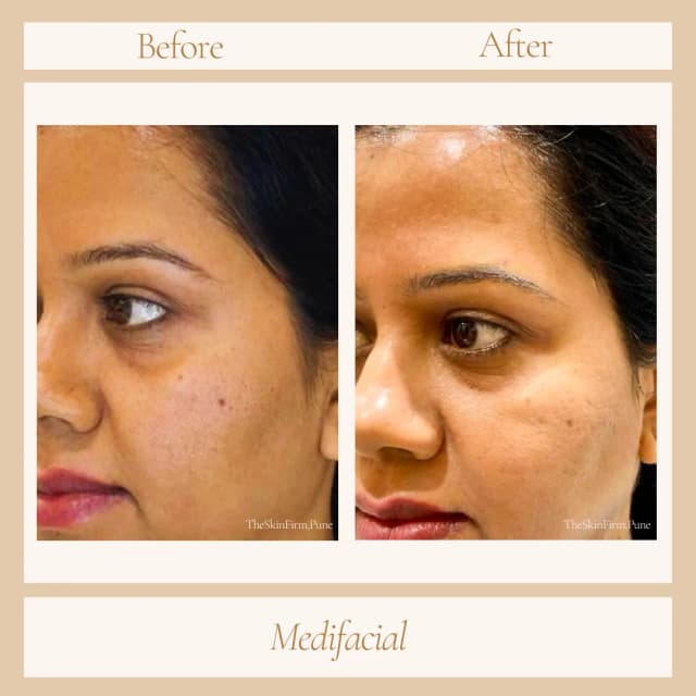 Facial