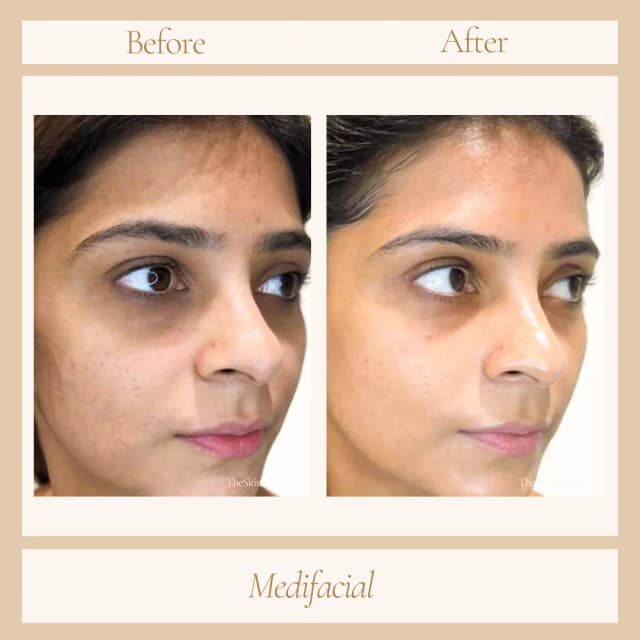 Facial