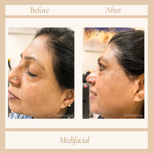 Facial