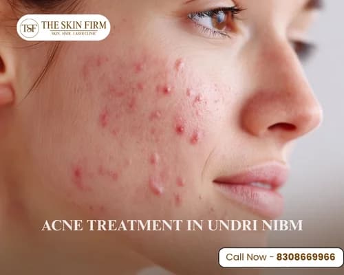 acne treatment in Undri NIBM