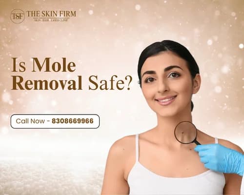 Mole Removal in Pune