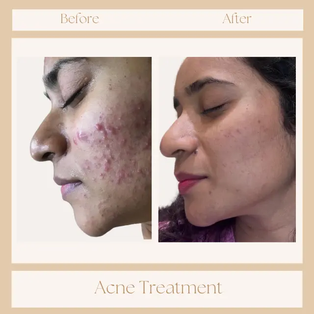 Acne treatment before after results