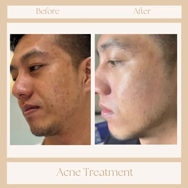 Acne treatment results