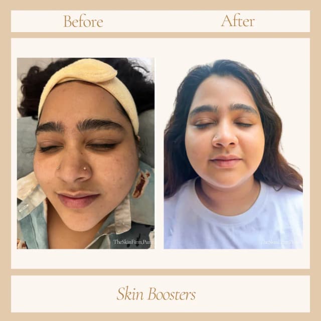 Skin Boosters