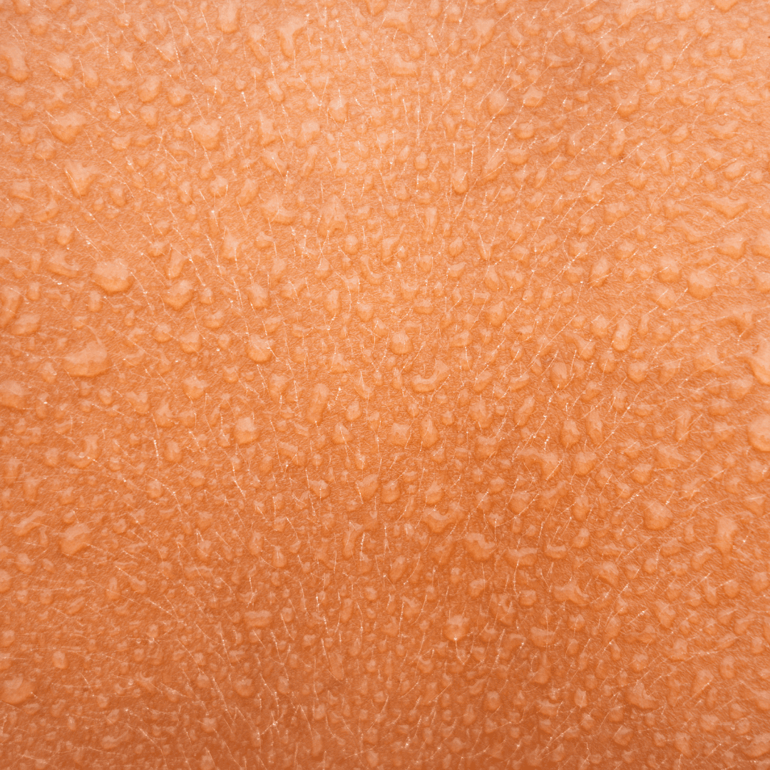 Hyperhidrosis Treatment