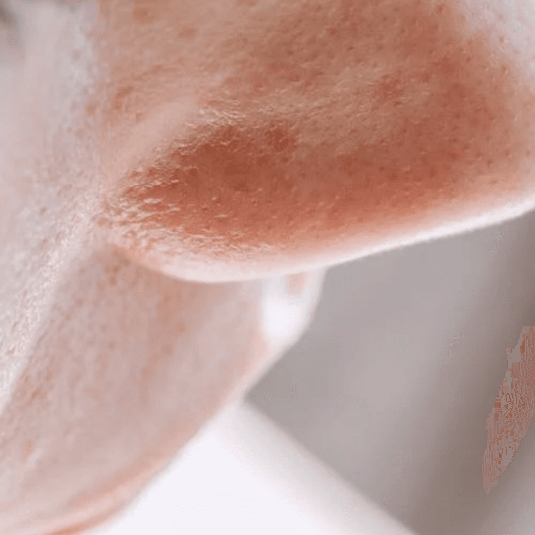 Open Pores Treatment