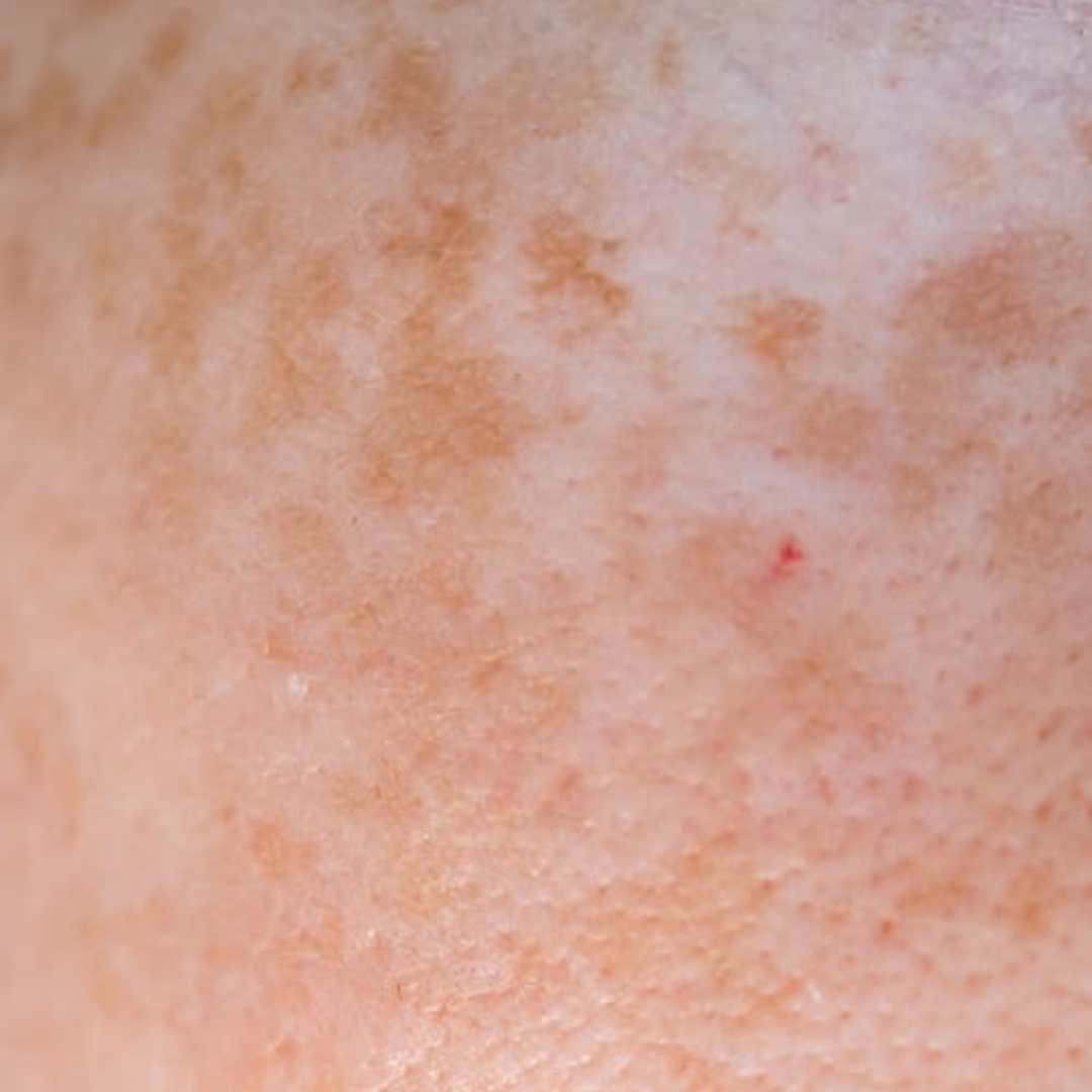 Skin Pigmentation & Melasma Treatment