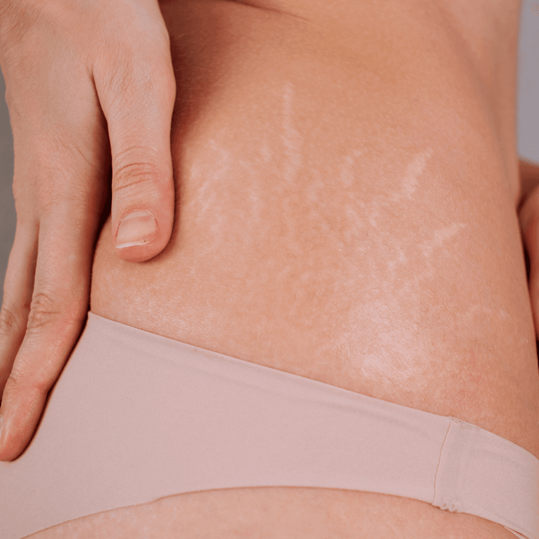 Stretch Marks Removal