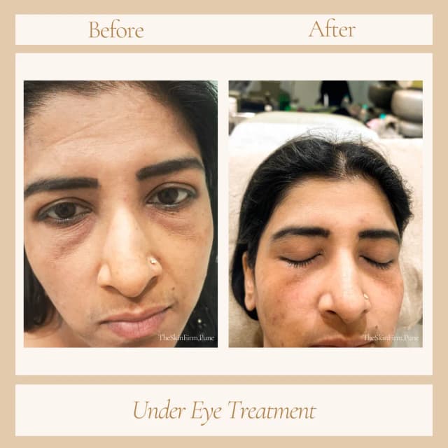 Under Eye Treatment