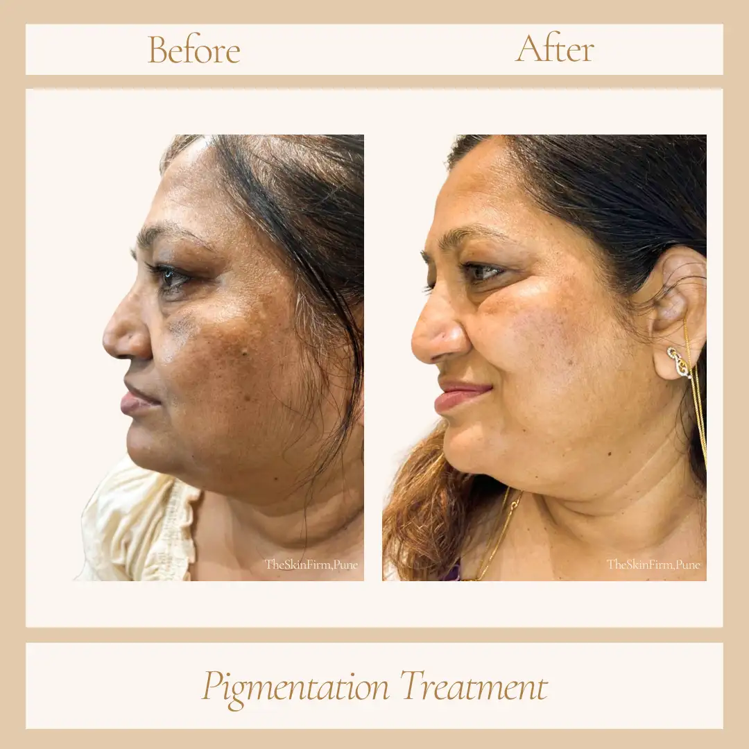 Treatment 6