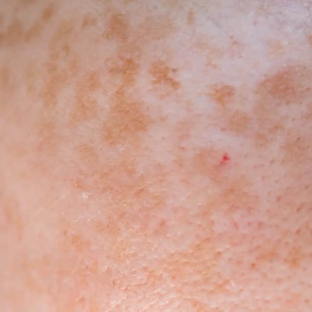 Pigmentation and Melasma Treatment