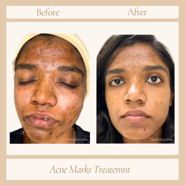 Acne Treatment