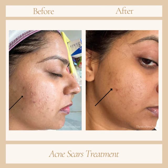 Acne Treatment