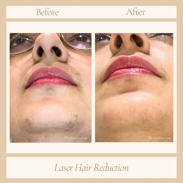 Laser Hair Removal