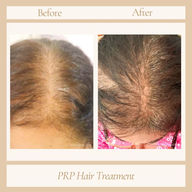 Hair Treatment