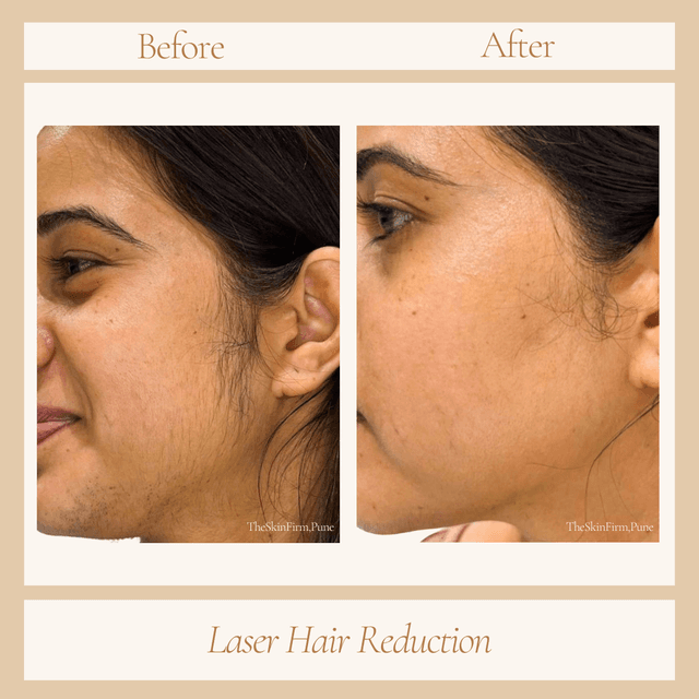 Laser Hair Removal