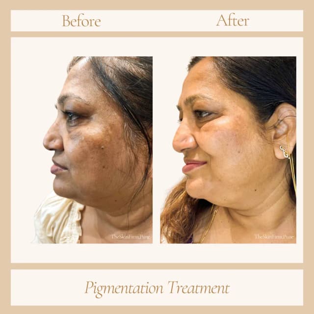 Pigmentation