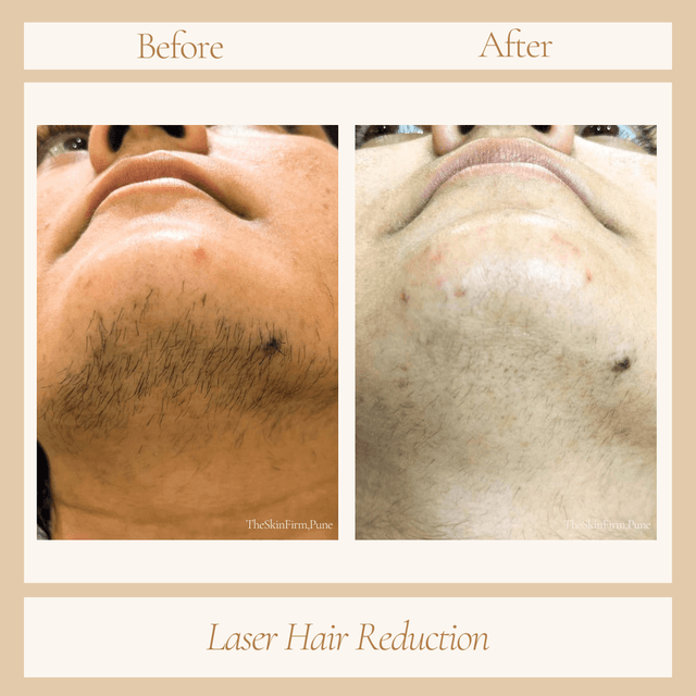 Laser Hair Removal Results