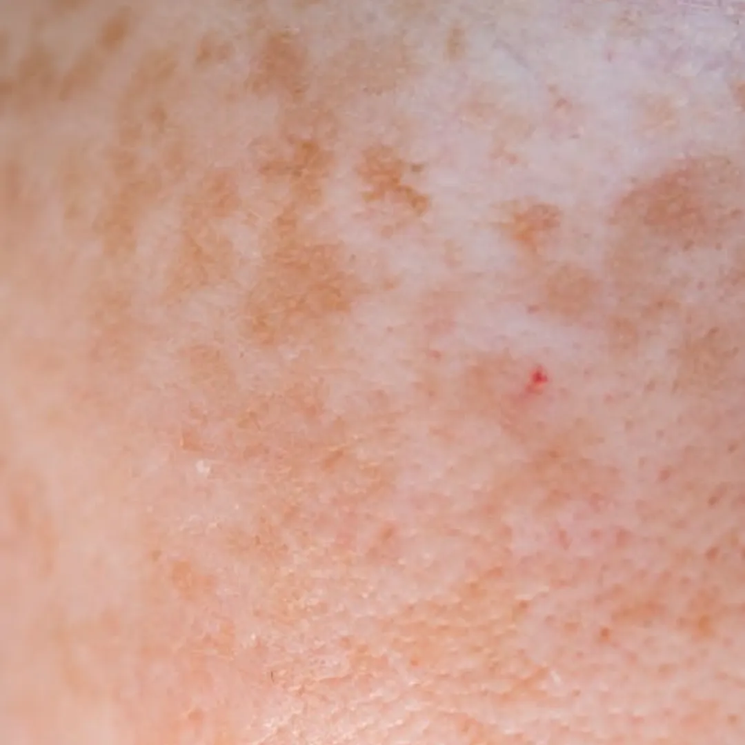 Skin Pigmentation & Melasma Treatment