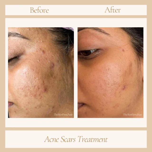 Acne Treatment