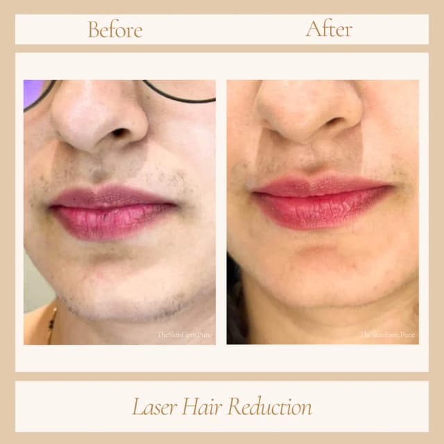 Laser Hair Removal 
