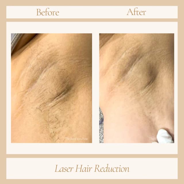 Laser Hair Removal 