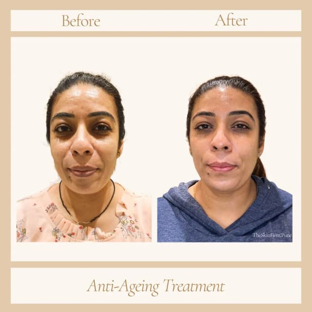 Anti Aging Treatment