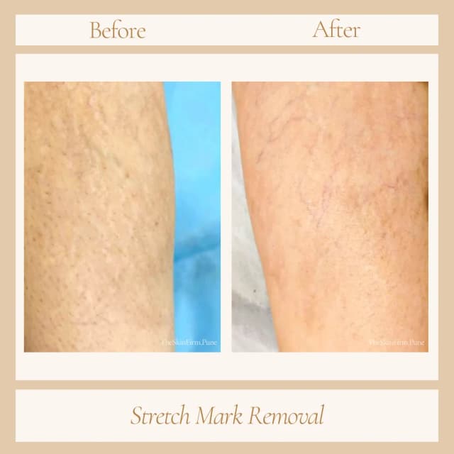 Stretch Marks