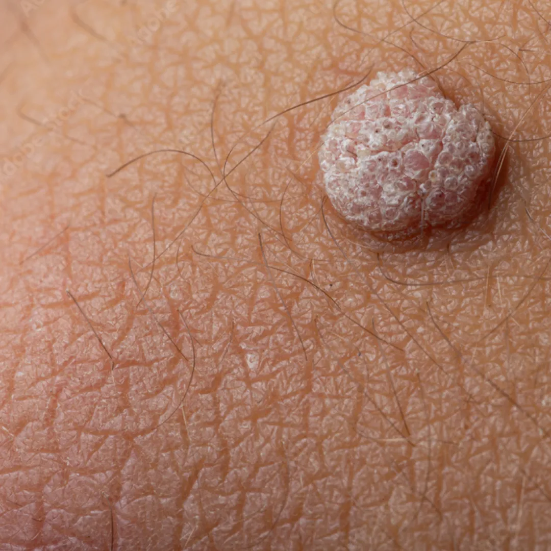 Wart Removal