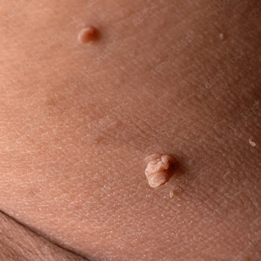 Mole & Skin Tag Removal