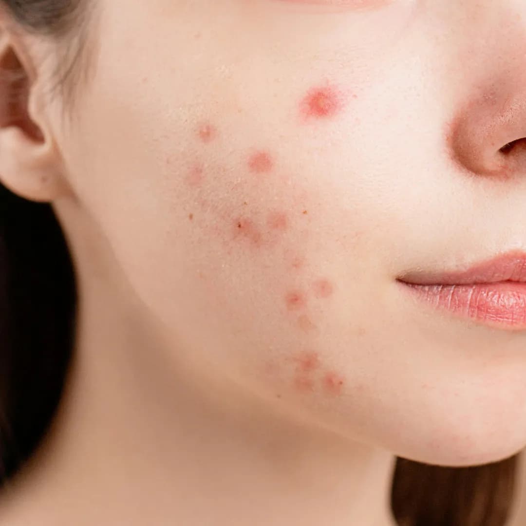 Acne Treatment