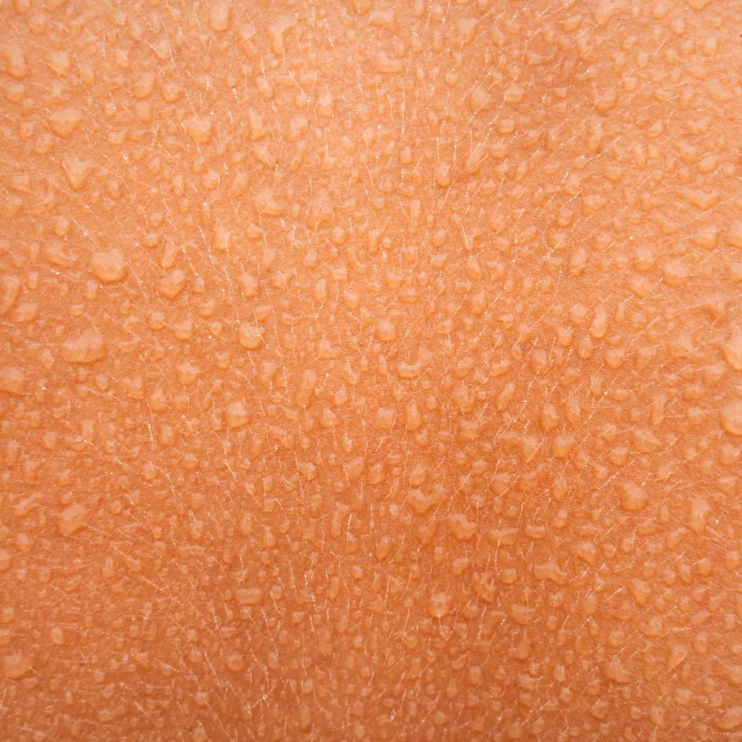 Hyperhidrosis Treatment
