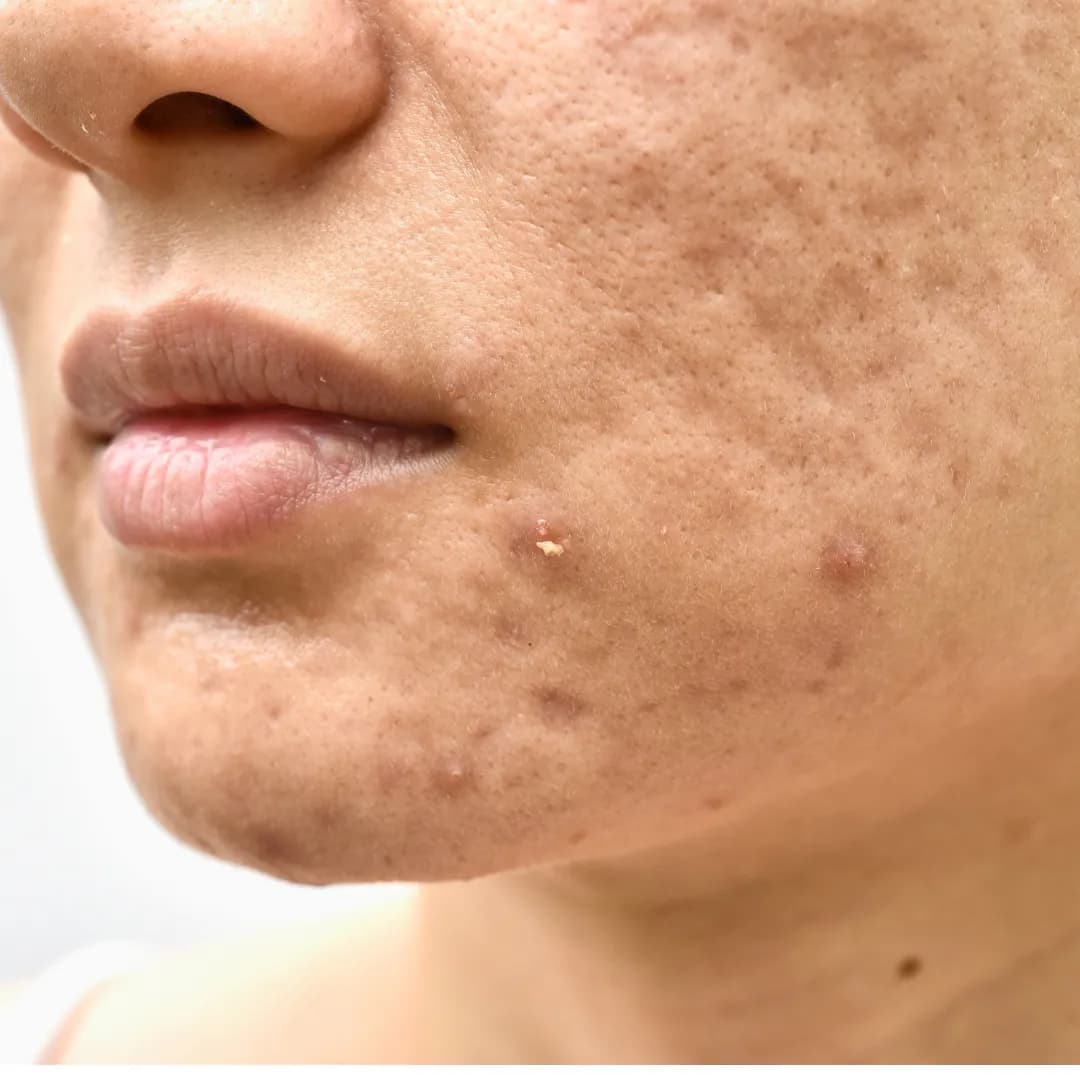 Acne Treatment in Kondhwa Pune 