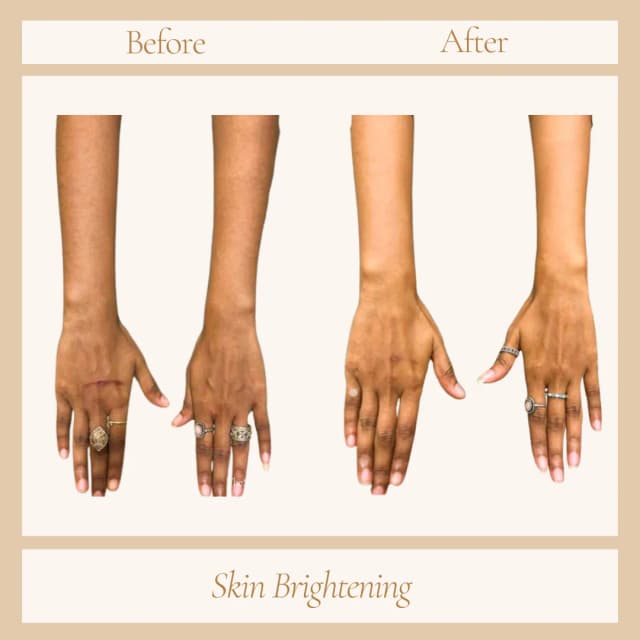 skin brightening Treatment
