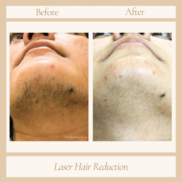 Laser Hair Removal