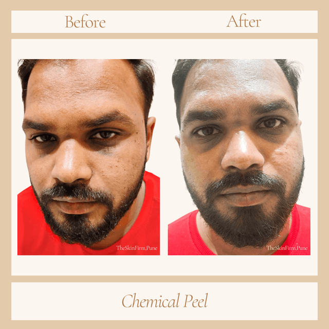 Chemical Peel