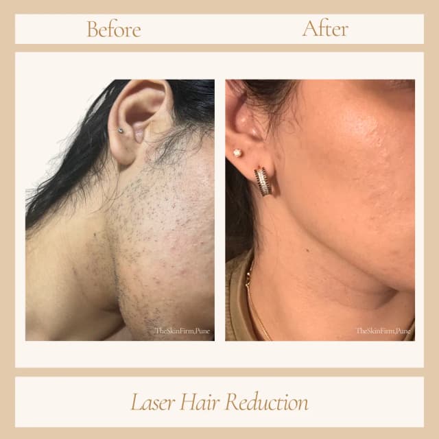 LHR- before after results