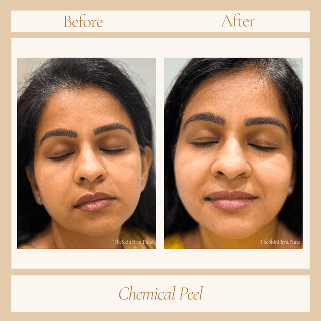 Chemical Peel