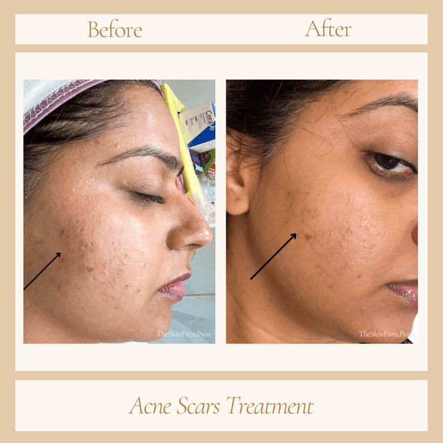Acne Scar Treatment