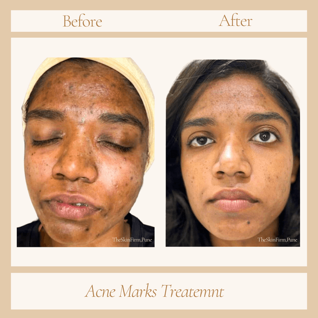 Acne Scar Treatment