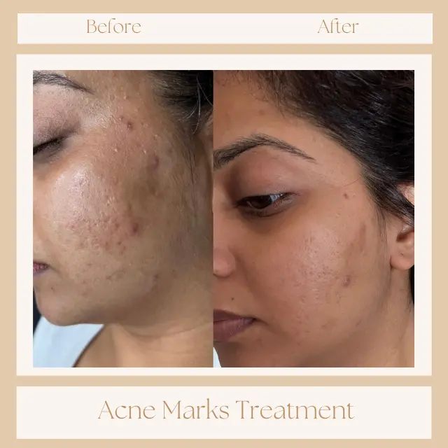 Best dermatologist in Pune for acne treatment