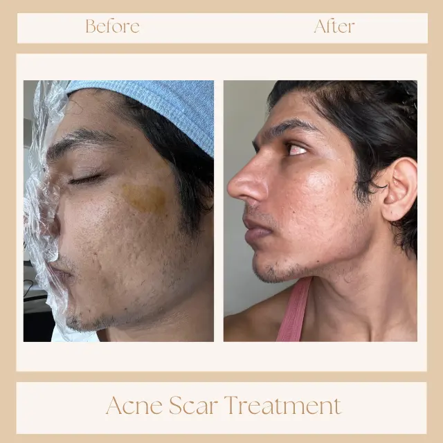 acne treatment Pune